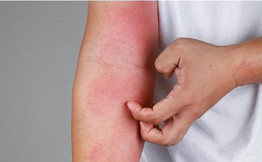 Kutiava atooppinen ihottuma